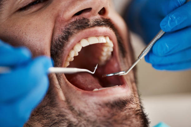 Best Emergency Tooth Extraction in Litchfield, MI