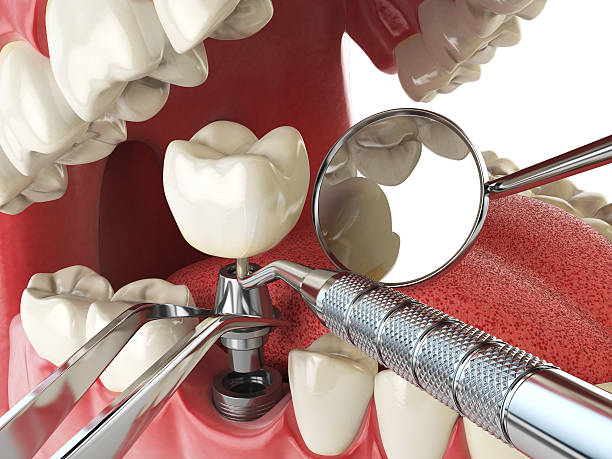 Best Emergency Tooth Extraction in Litchfield, MI